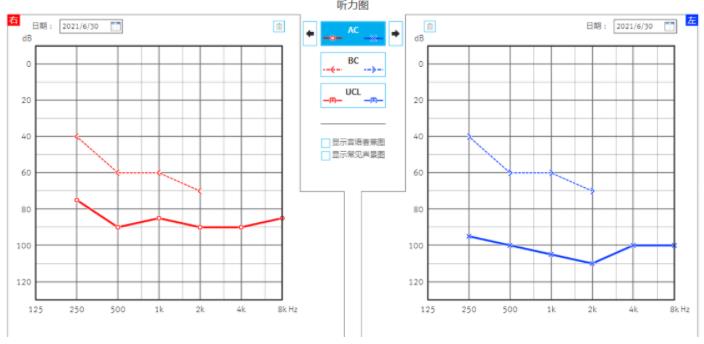 张爷爷听力检查图