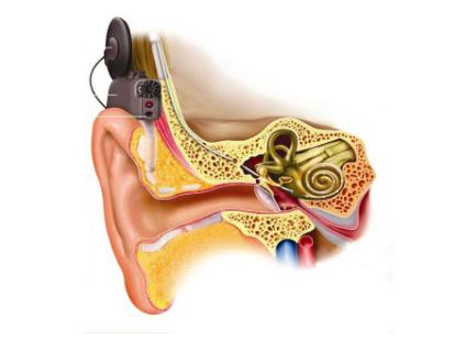 人工耳蜗和和助听器怎么搭配？(图2)